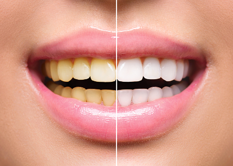 Oasis Dental Teeth Whitening Special Oasis Dental Teeth Whitening Special
